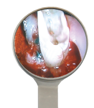 HD Rhodium Mouth Mirror Size 5
