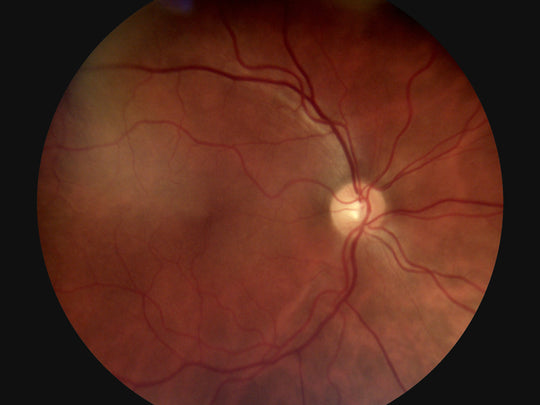 45° Auto Focus Portable Fundus Camera - ER200245
