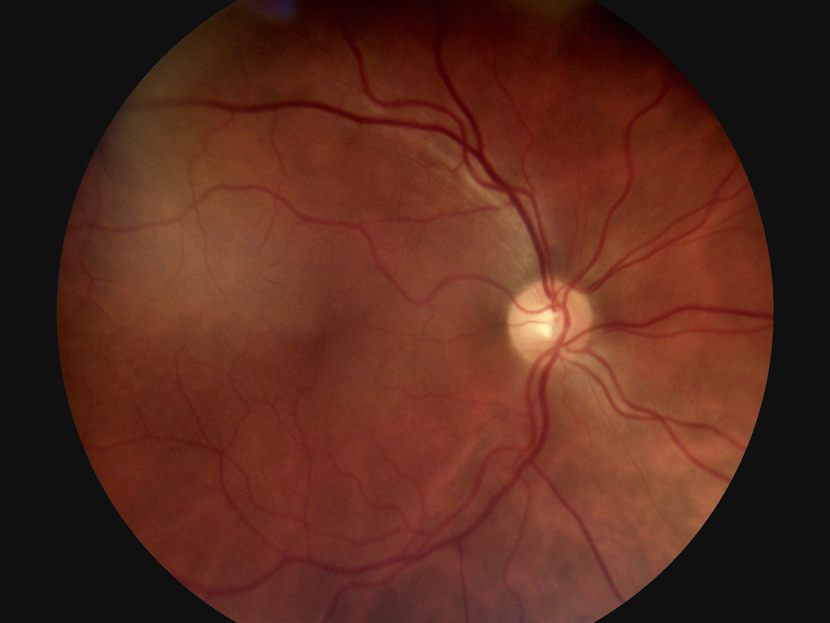 45° Auto Focus Portable Fundus Camera