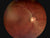 45° Auto Focus Portable Fundus Camera