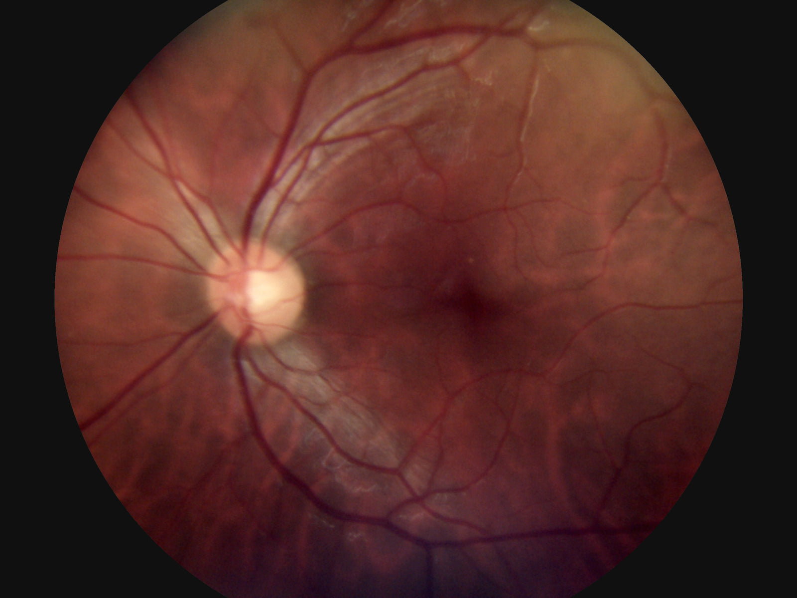 45° Auto Focus Portable Fundus Camera