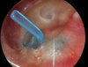 Tympanostomy U-Tube