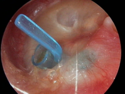 Tympanostomy U-Tube