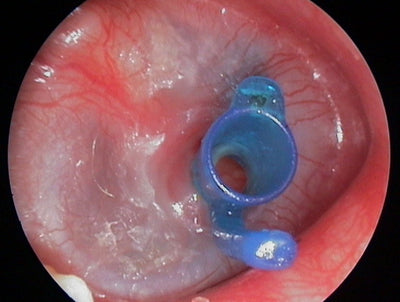 Tympanostomy U-Tube