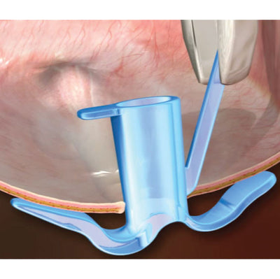 Tympanostomy U-Tube